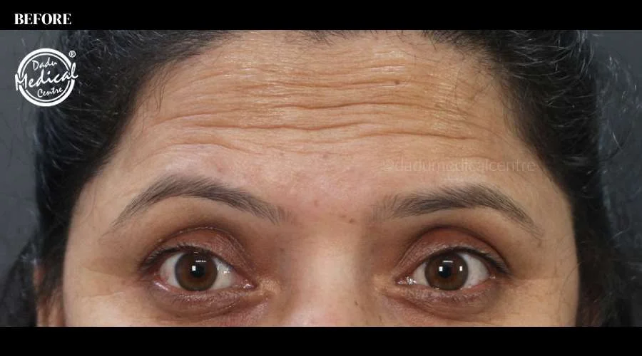 Forehead Lines - before