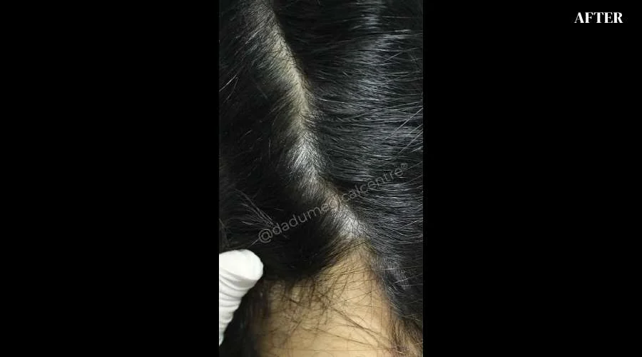 Dandruff - after